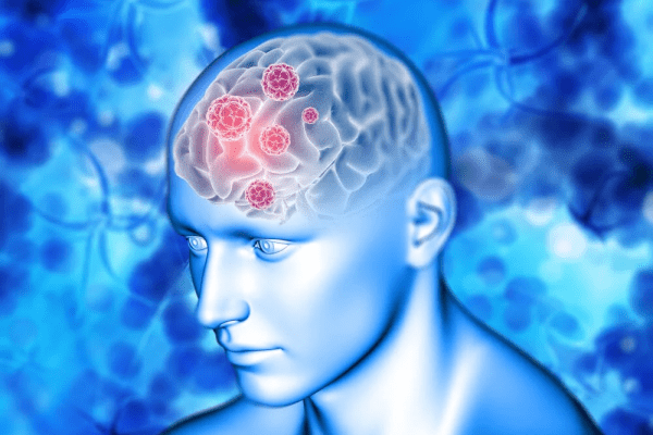Illustration of a human brain highlighting tumor location, symbolizing early detection and treatment importance
